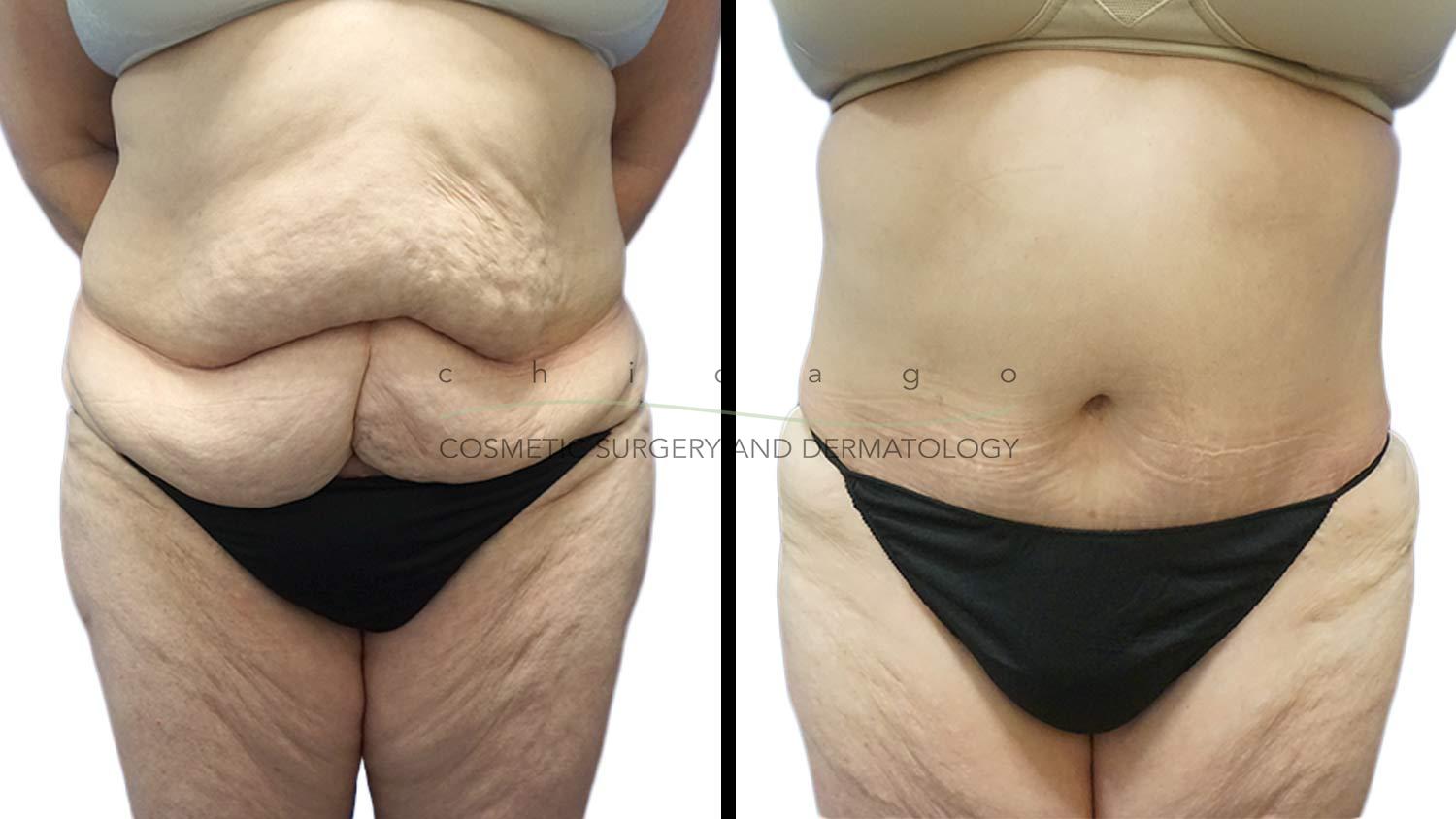 Body contouring after massive weightloss by Dr. Niki Christopoulos