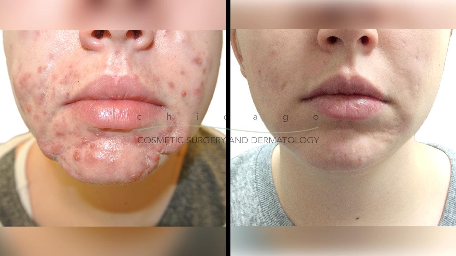 Acne before and after tretinoin
