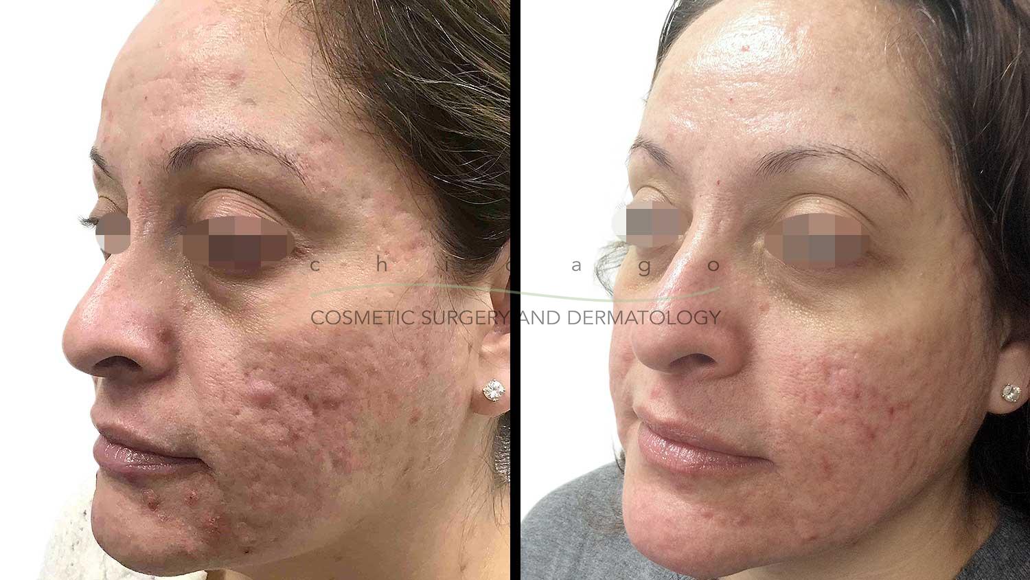 laser resurfacing before and after
