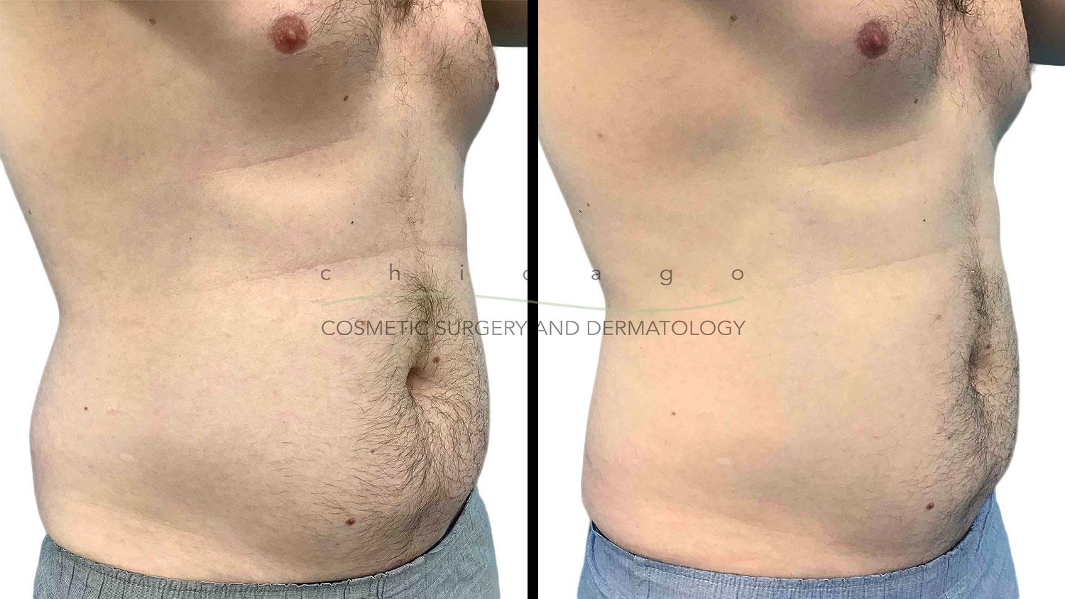 CoolSculpting before and after chicago