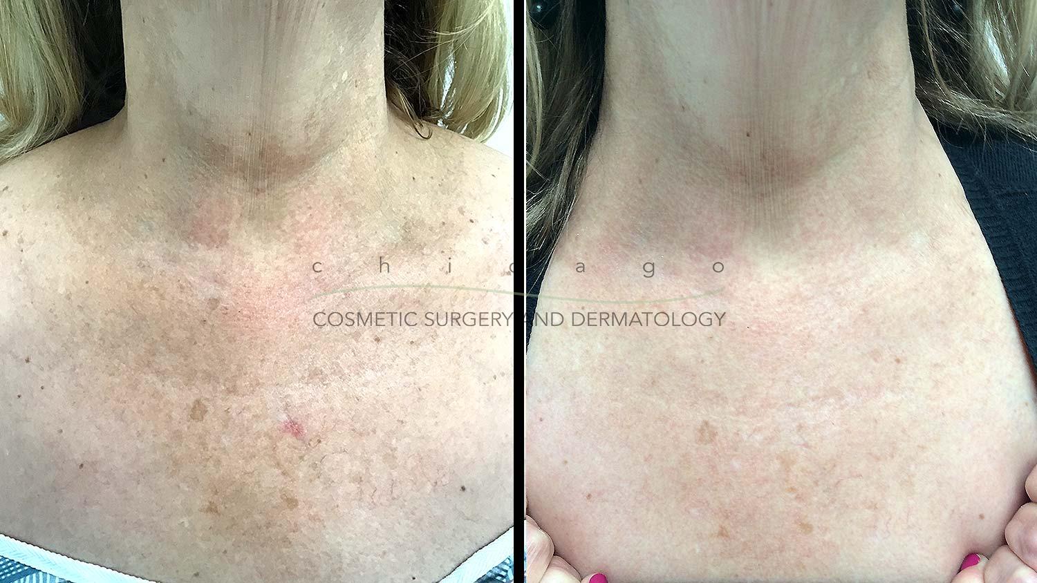 Fraxel laser before and after