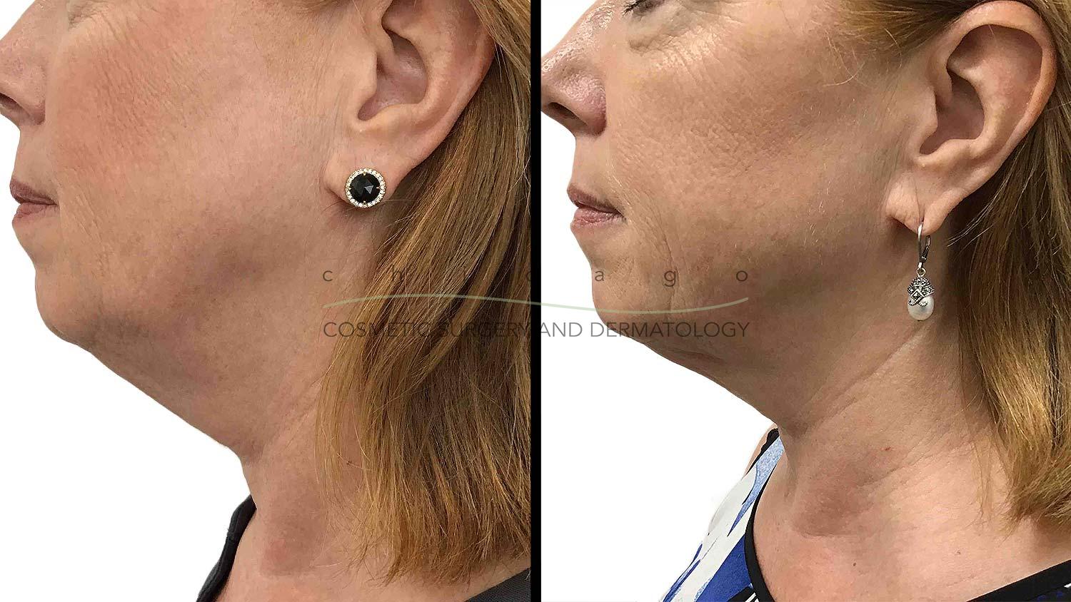Kybella by Dr. Omer Ibrahim