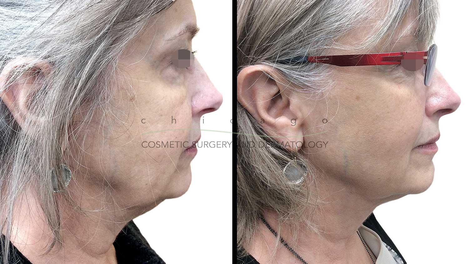 Kybella for double chin results