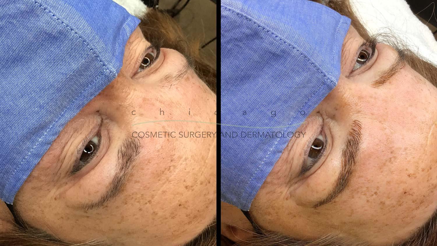 Eyebrow Microblading before and after