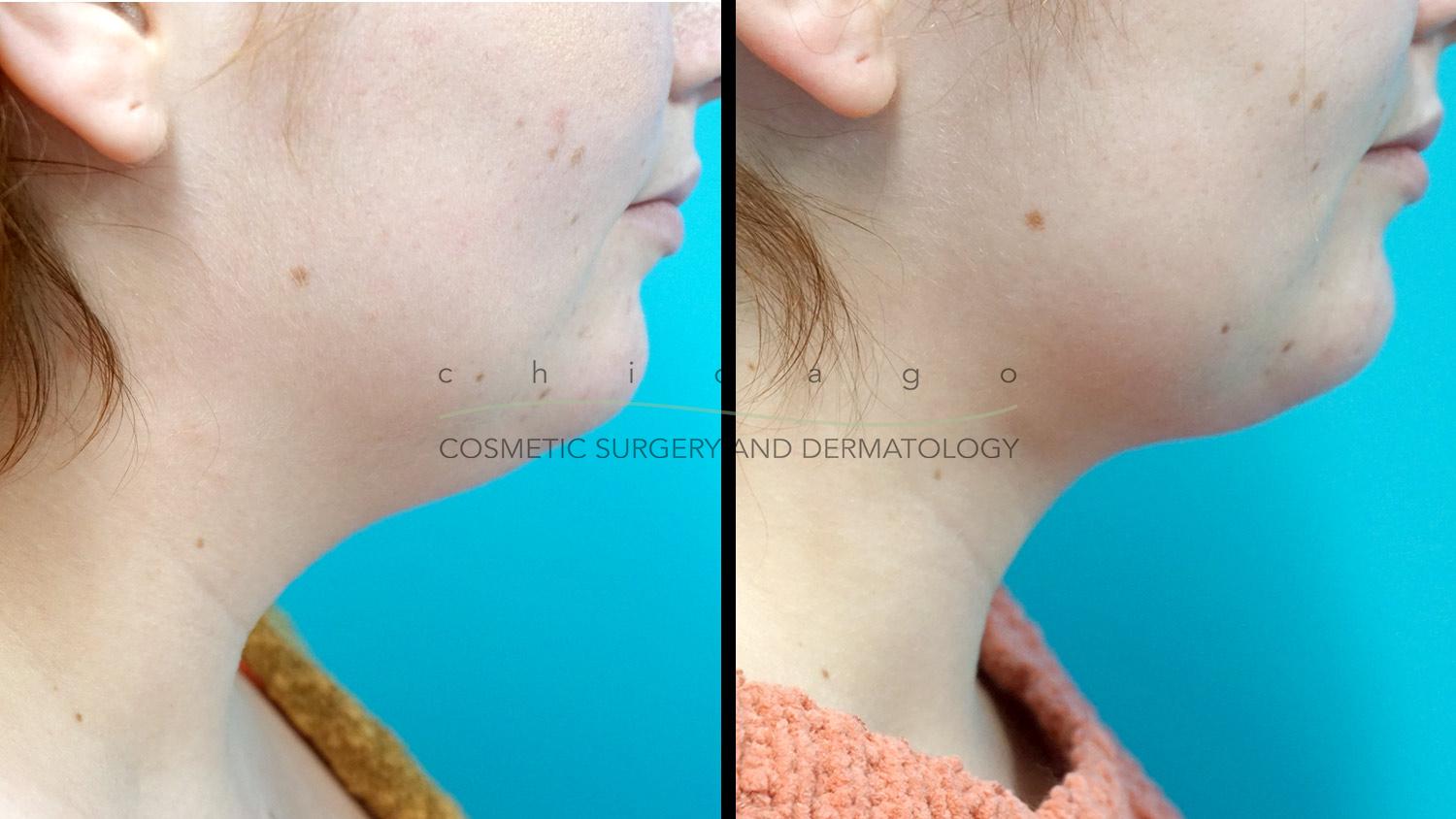 neck liposuction before and after chicago