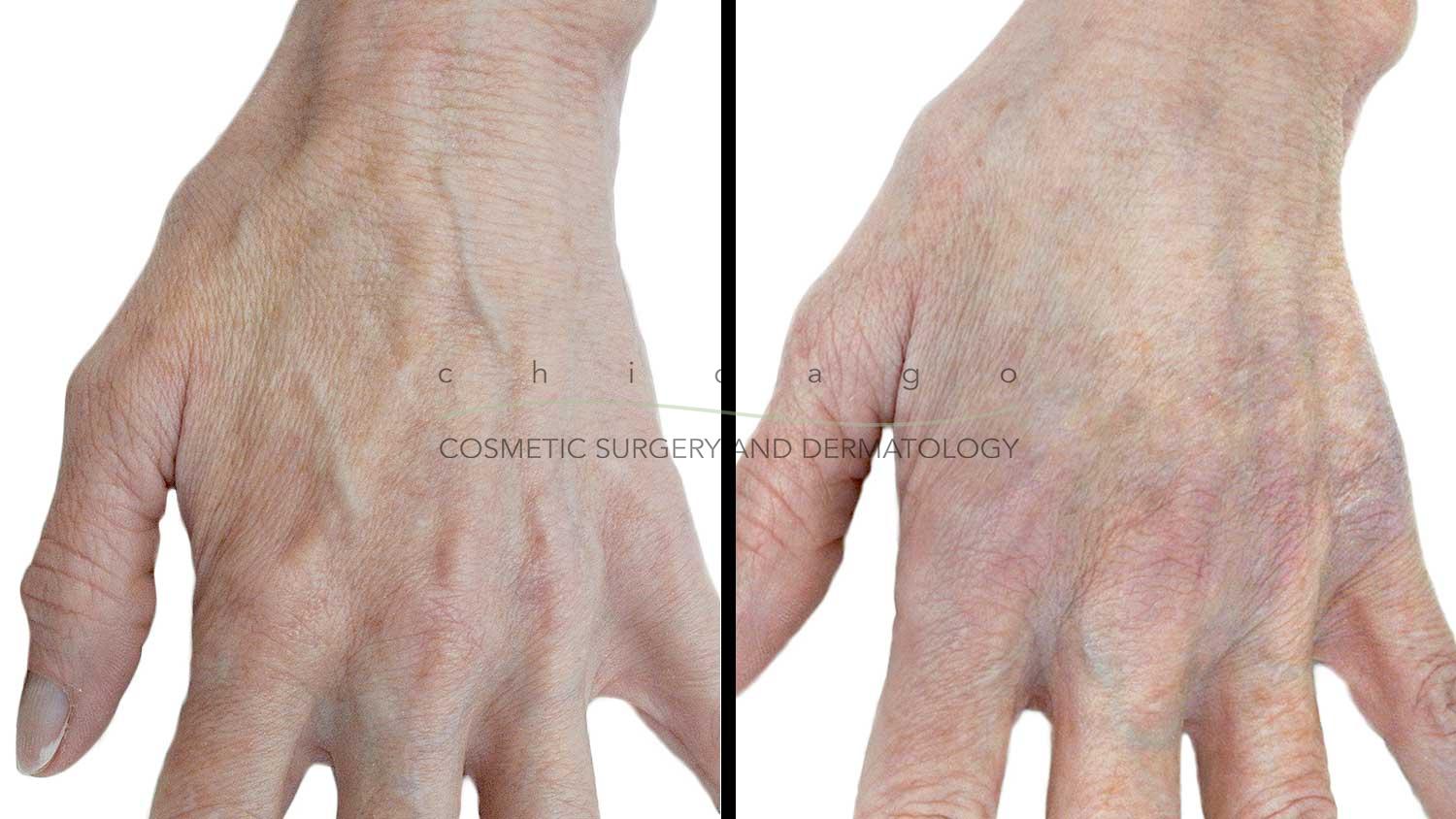 radiesse hand rejuvenation results