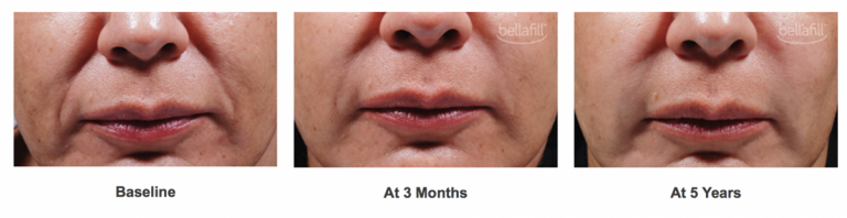 Before & After results Bellafill® Treatment