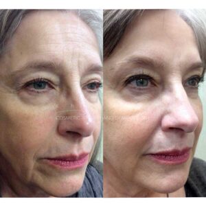 monthly specials sculptra