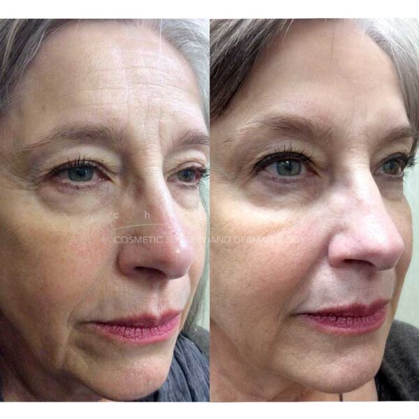 monthly specials sculptra