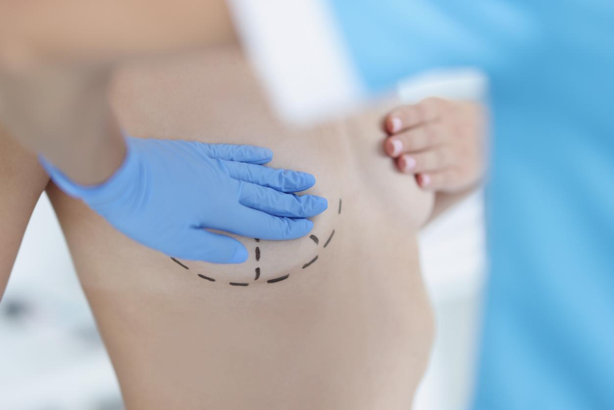 Concentric markings show where surgeon will cut during breast augmentation procedure.
