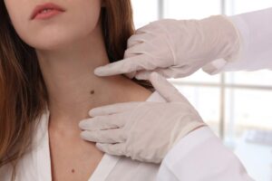 Attractive brunette female wearing white shirt has mole on neck examined by doctor wearing latex gloves.